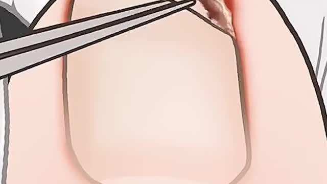 Removing ingrown toenail (animated)