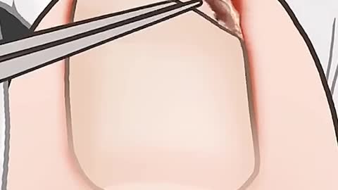 Removing ingrown toenail (animated)