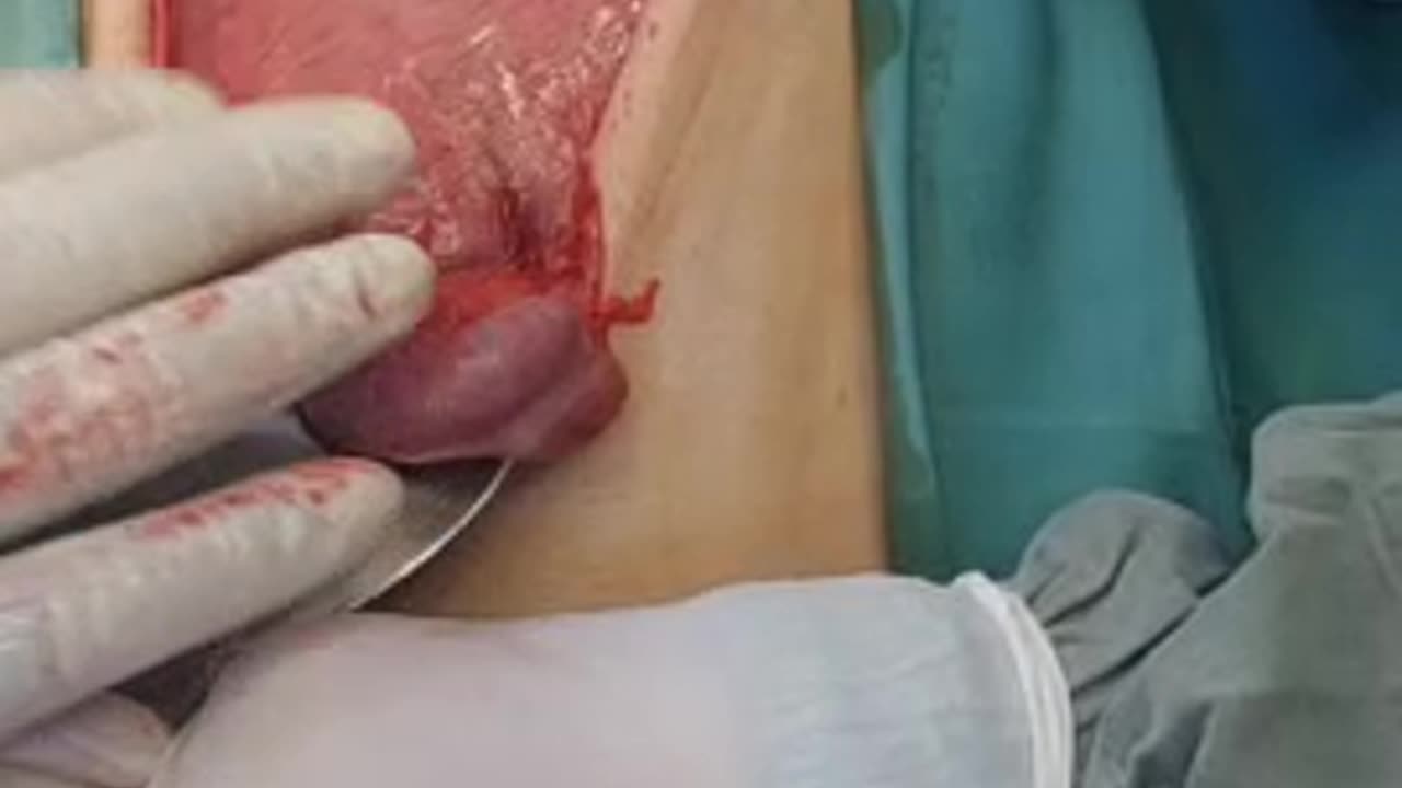 🖥 Distended stomach due to pyloric stenosis