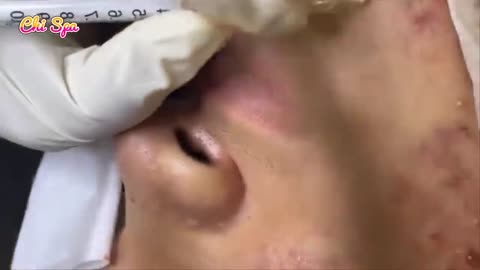 Beauty care - popping blackheads