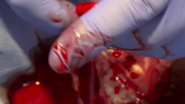 Warning, graphical imagery… This video was taken by a heart surgeon