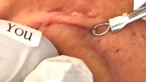 Blackhead Removal Videos 2021- Ear Blackheads Removal | Best pimple popper videos 2021