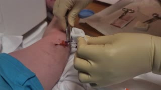 PICC line removal