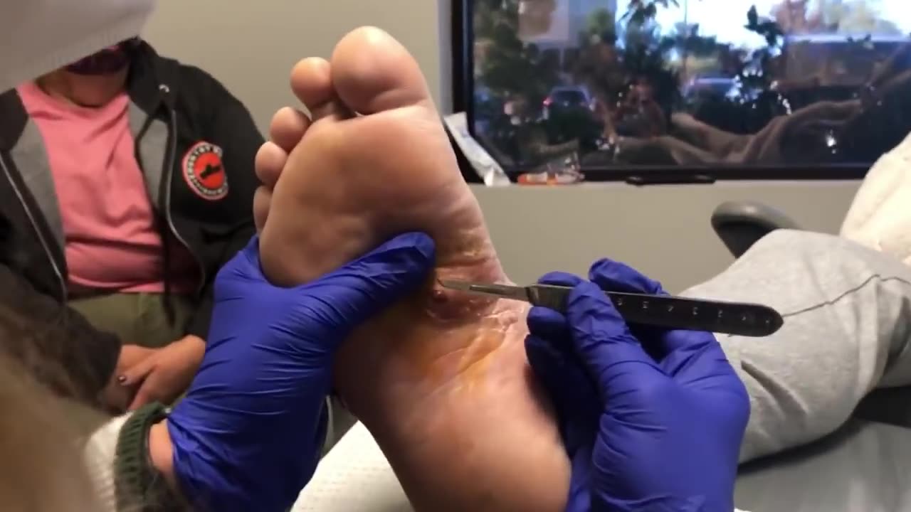 INSANE INCLUSION CYST