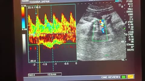 Scanty liquor with Male Gender at 35 week with Labor Pains and Anterior Placenta