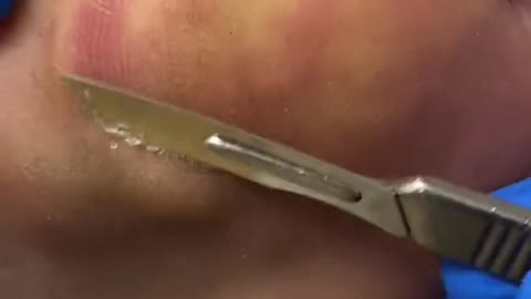 Forefoot callus removal and smoothing by Australian podiatrist