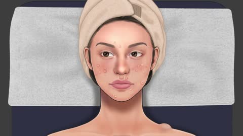 [ASMR] Acne, Big Blackhead Removal Animation