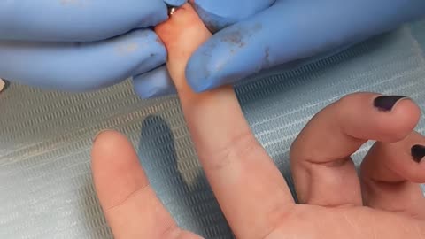 Titan Biomagnet Install