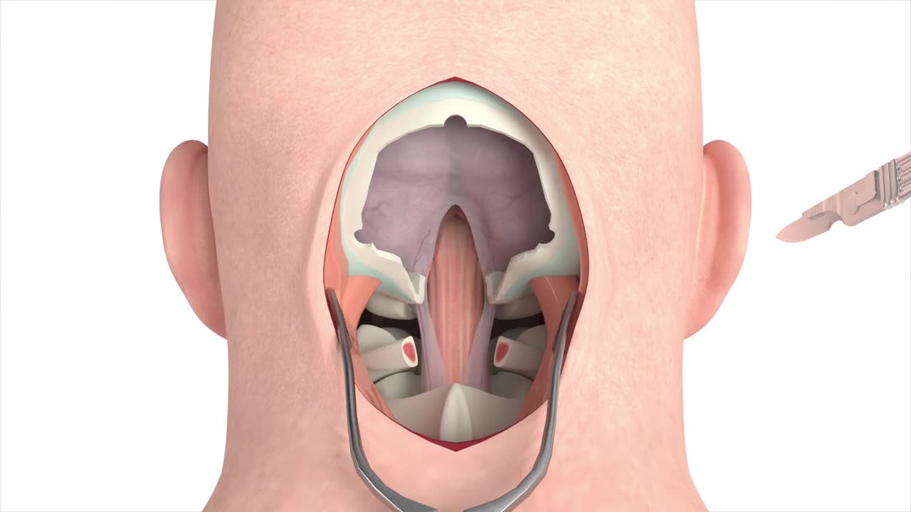 Craniectomy surgical procedure - 3D animation