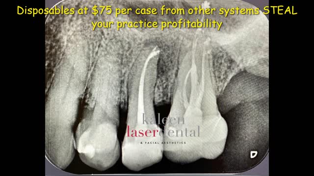 Dentist can do better Root Canals without the High cost of Disposables