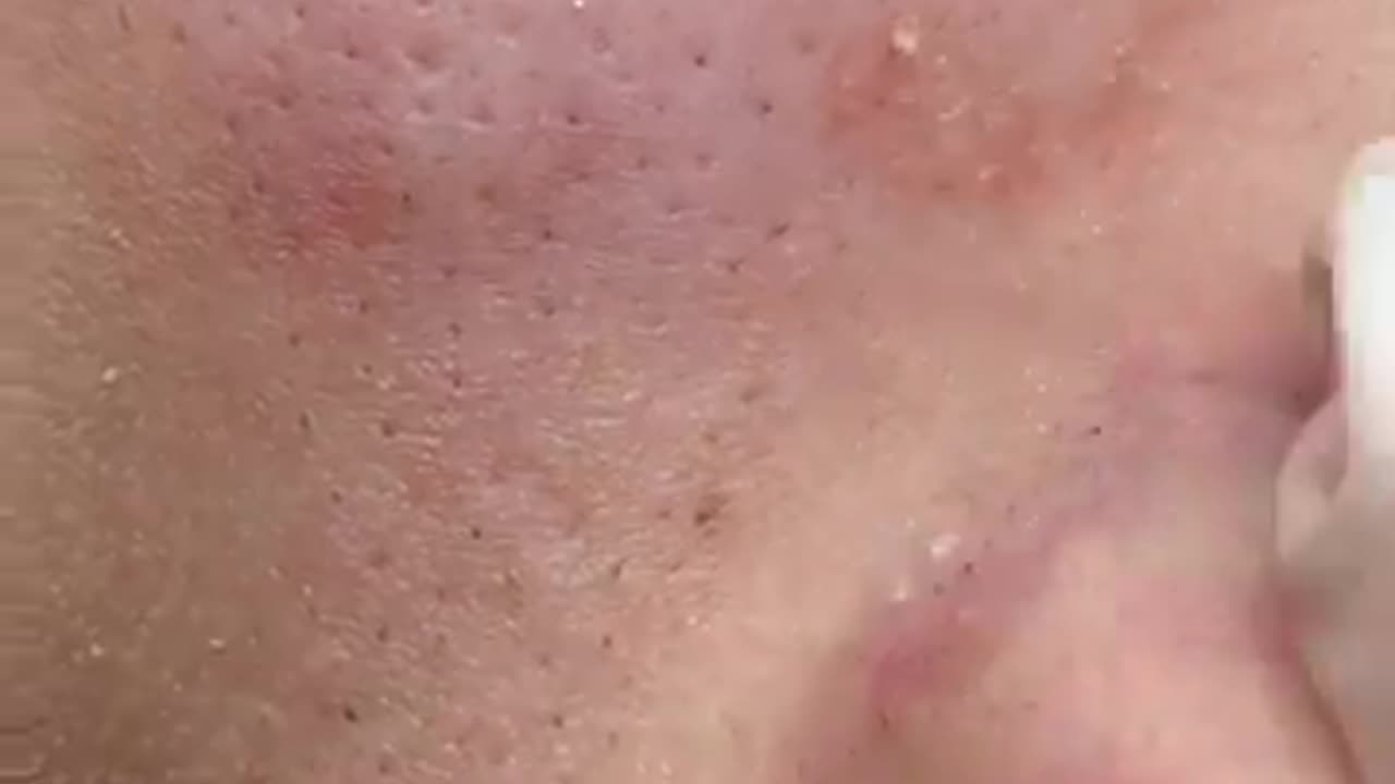 Face remove pimples