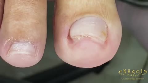 Medicure Rotten Toenails so Satisfying