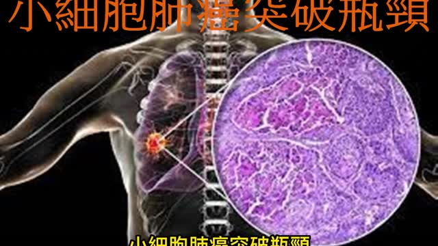 免疫療法 小細胞肺癌突破瓶頸