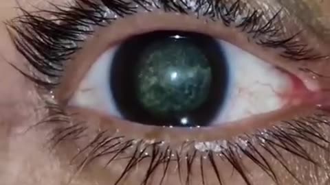 Hialosis asteroidea is a condition that makes your eyes look like stars in a galaxy.