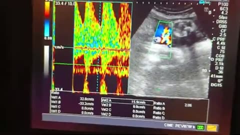 Placenta Previa with Male Gender and 35 Weeks and Labor Pain 😮‍💨😮‍💨