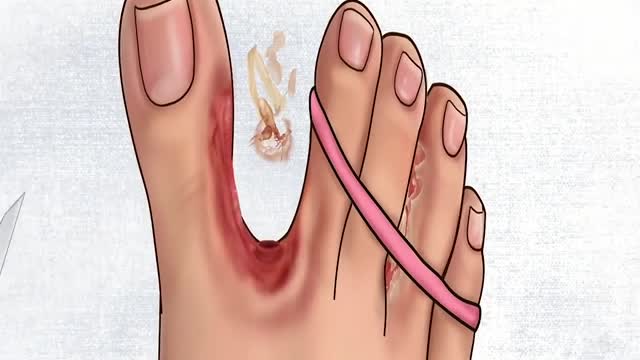 ASMR Treatment Athlet´s Foot And Warts | Satisfaying Video | Relaxing Videos