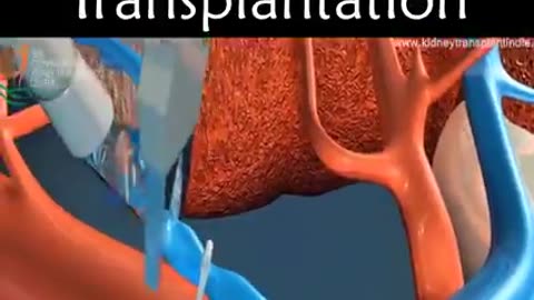 Kidney transplantation