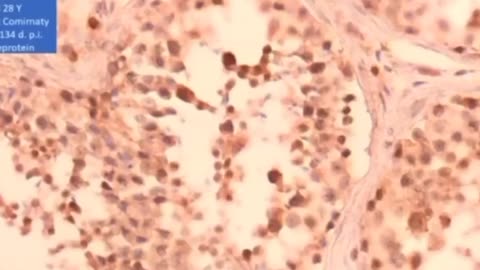 Spike Protein Replacing Sperm - Dr. Arne Burkhardt