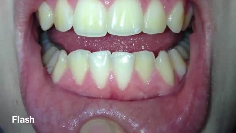 How I whitened my VERY yellow teeth! (WORKS!) BEFORE AND AFTER!