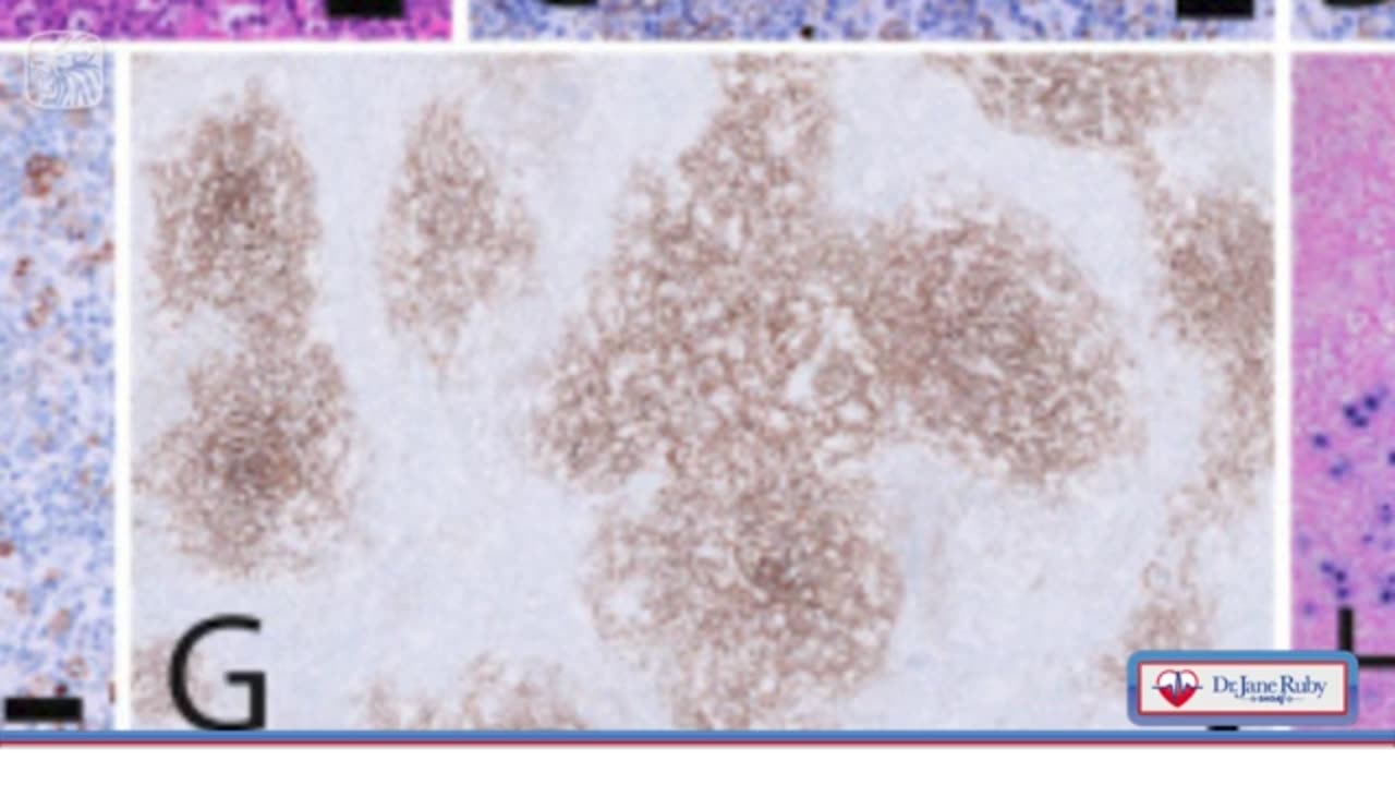 Cancer Exploding in the Boosted & HIV in the Bioweapon Shots