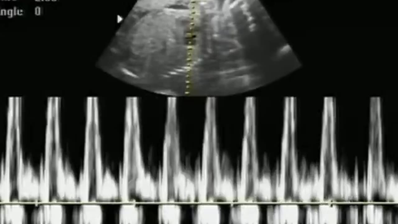 WOW! Unborn Baby's Heartbeat