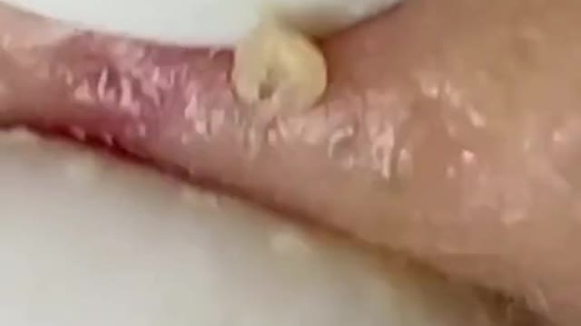 Blackheads & Milia, Big Cystic Acne Blackheads Extraction whiteheads Removal pimple Popping