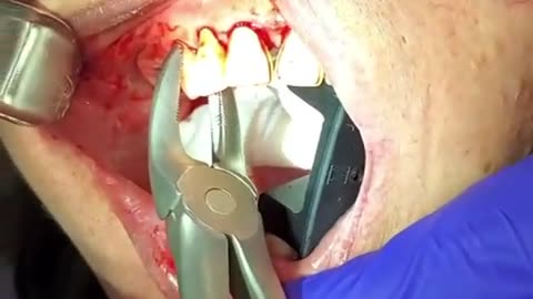 Easy tooth extraction