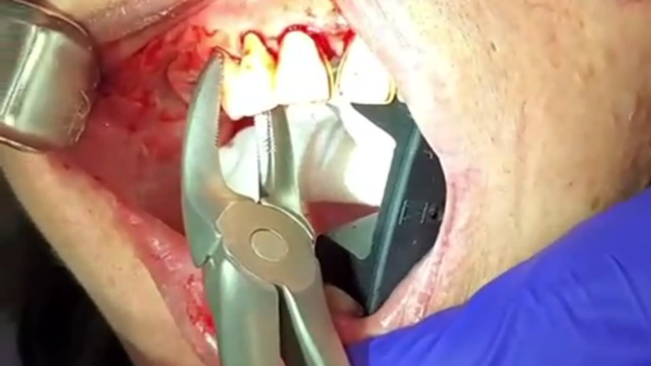 Easy tooth extraction