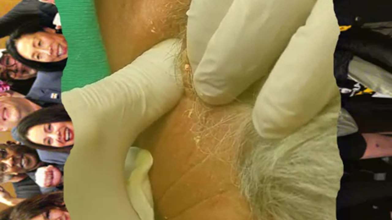 Pimple popping and blackhead