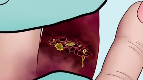 ASMR Treatment Maggot Infested Finger #asmr #satisfying #trendingshort #viral #shorts #trending