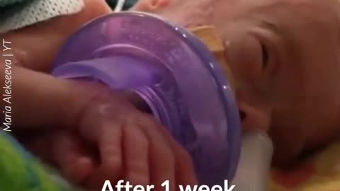 MIRACLE BABY LESS THAN A POUND