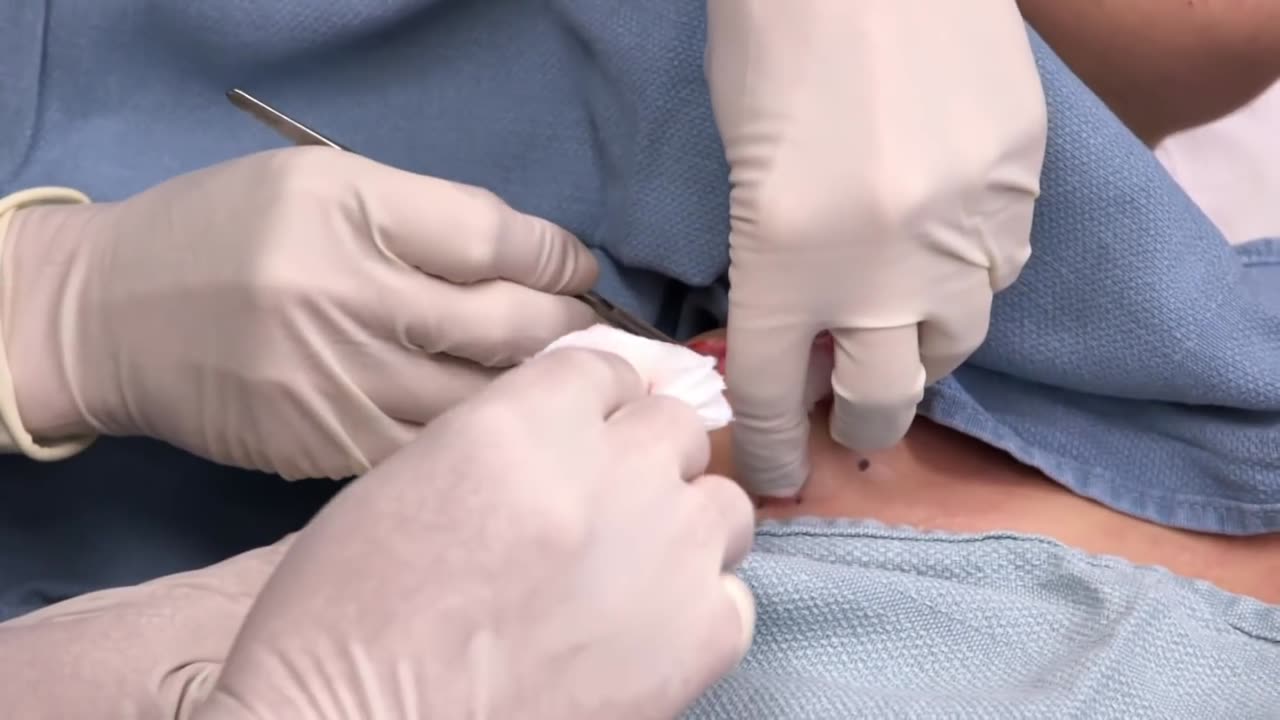 8 Satisfying Minutes Of Popping Cysts, Lipomas And Blackheads! Dr. Pimple Popper