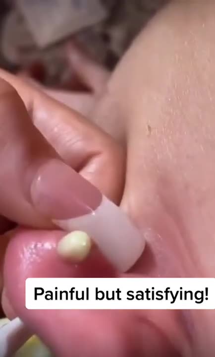 Pimple Popping - Blackheads & Whiteheads #