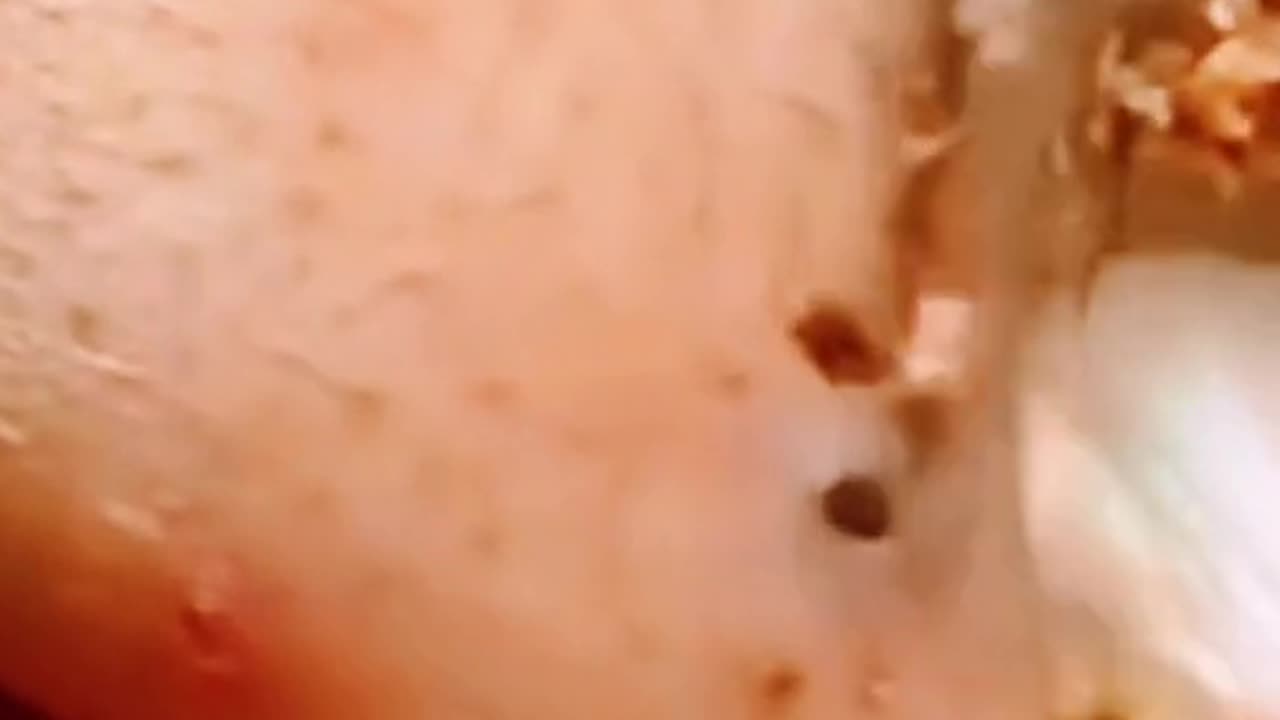 Huge blackhead extraction