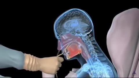 THE PROCEDURE FOR INSERTING A NASOGASTRIC TUBE