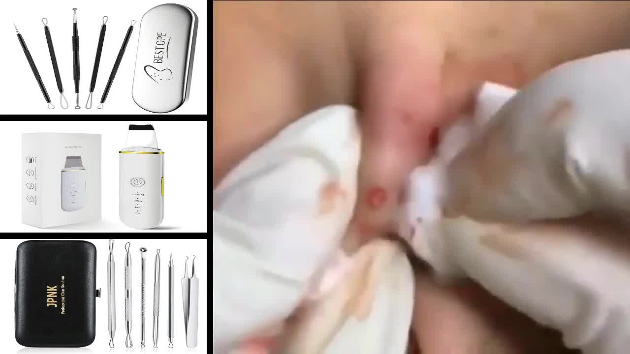 Blackheads Removal & Pimple Popping Videos 2022