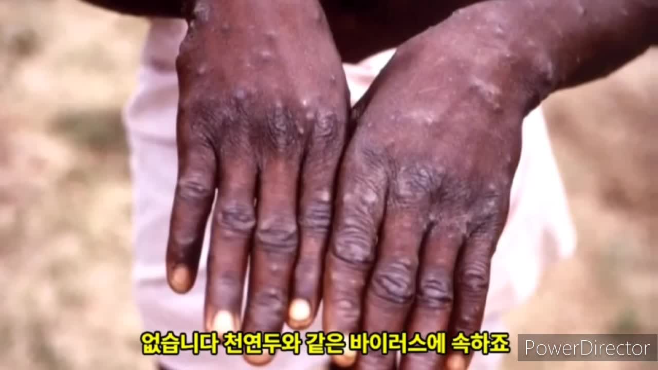 조커뉴스// 원숭이 두창 백신
