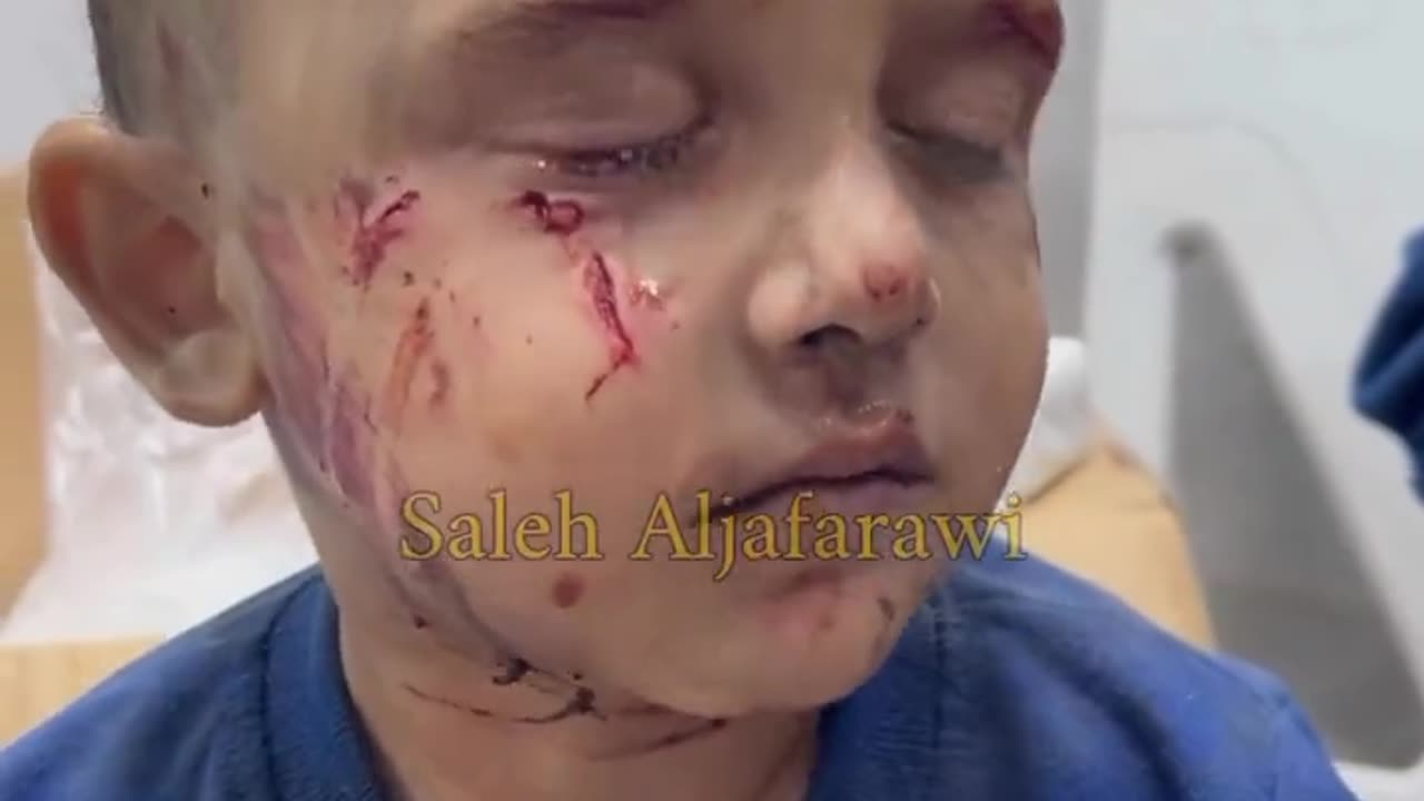 Little Palestinian Bombing Victim Fights His Tears