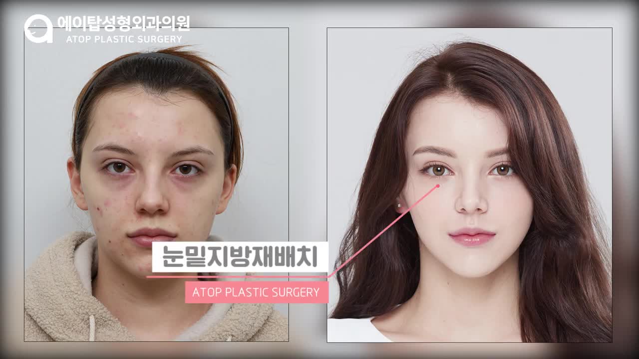 【ATOP】국내 뿐만 아니라, 외국인도 인정하는 글로벌 성형외과에이탑성형외과ATOP plastic surgery