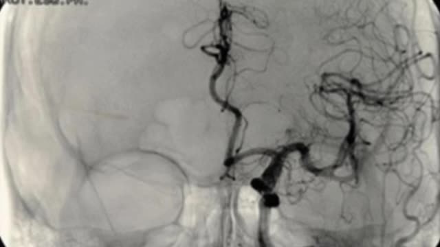 Multiple Brain Aneurysms - Given A 3-6 Month Life Expectancy - Fully Vaccinated (Jan. 2023)
