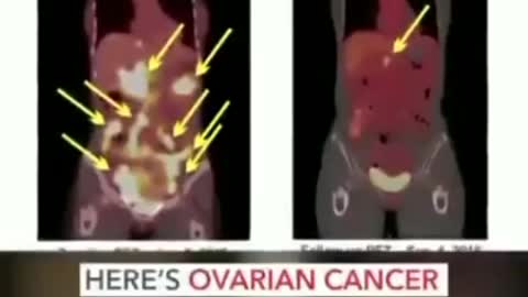 A cure for cancer
