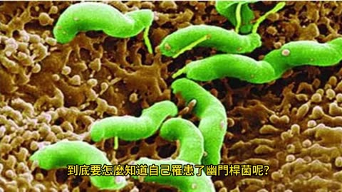 幽門桿菌 不治療成胃癌
