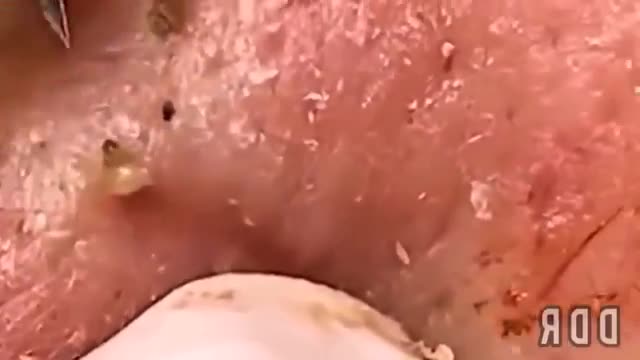 Blackhead removal extraction