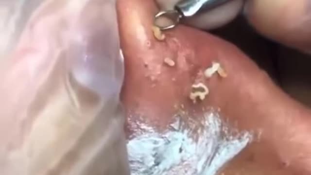 Blackhead Removal - Pimple popping - Acne Treatment - 18 #shorts