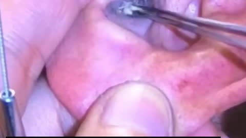 Ear wax removal