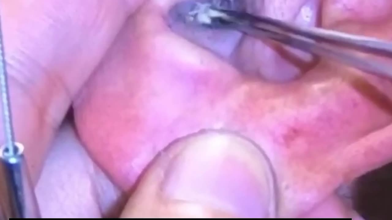 Ear wax removal