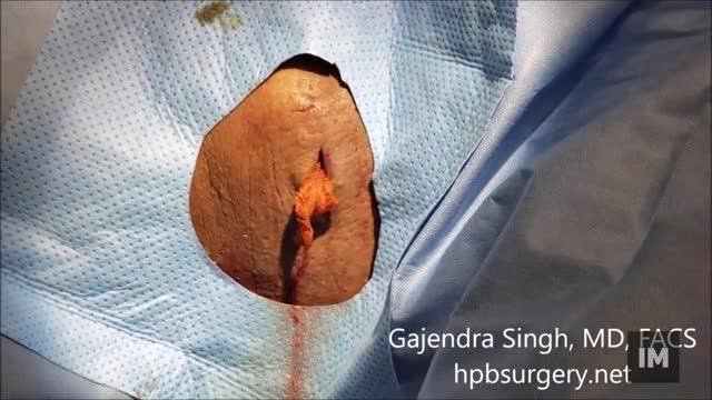 Large Abscess of the Thigh Incision and Drainage Gross