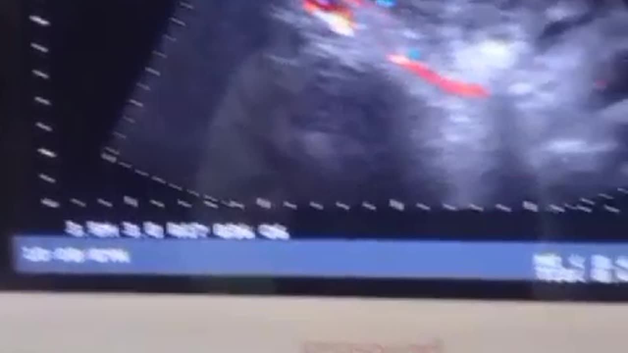 It's ultrasound video