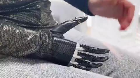 Bebionic Hand Is What Is Known As A Myoelectrically Controlled Hand Prosthesis ~You Can Control It With Your Own Muscle Signals In The Residual Limb