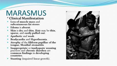 Pediatric Malnutrition